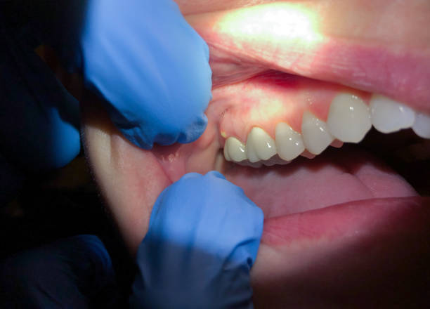 Best Emergency Wisdom Tooth Extraction in Red Hill, SC