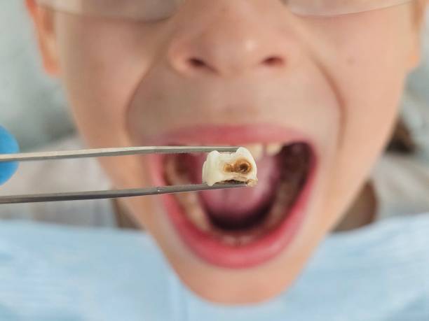 Best Broken or Chipped Tooth Repair in Red Hill, SC